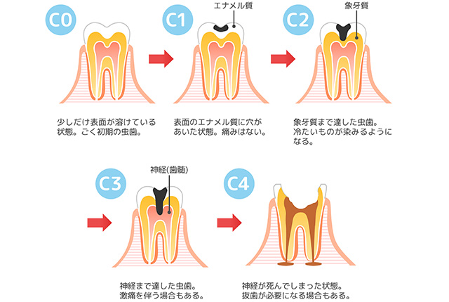 虫歯の進行