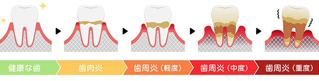 歯周病の進行